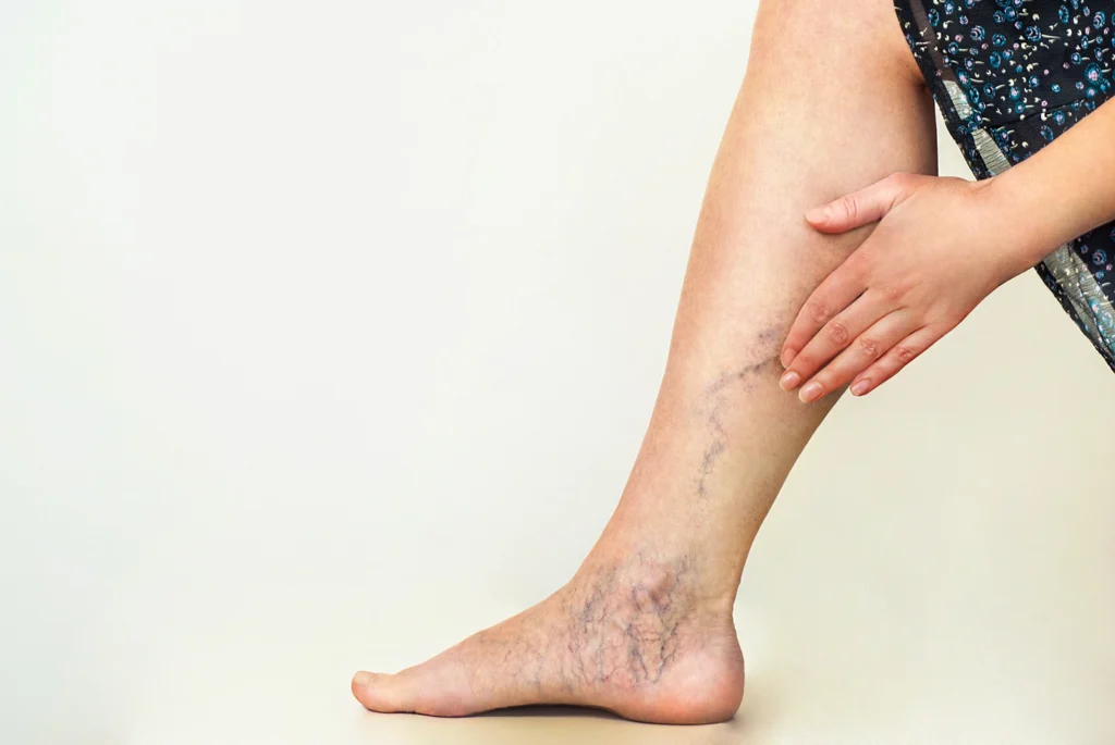 Venous Leg